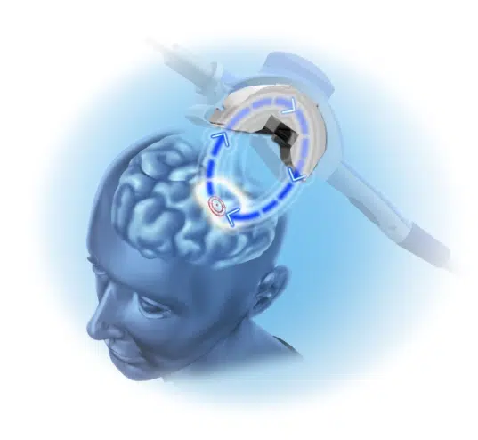NeuroStar brain stimulation