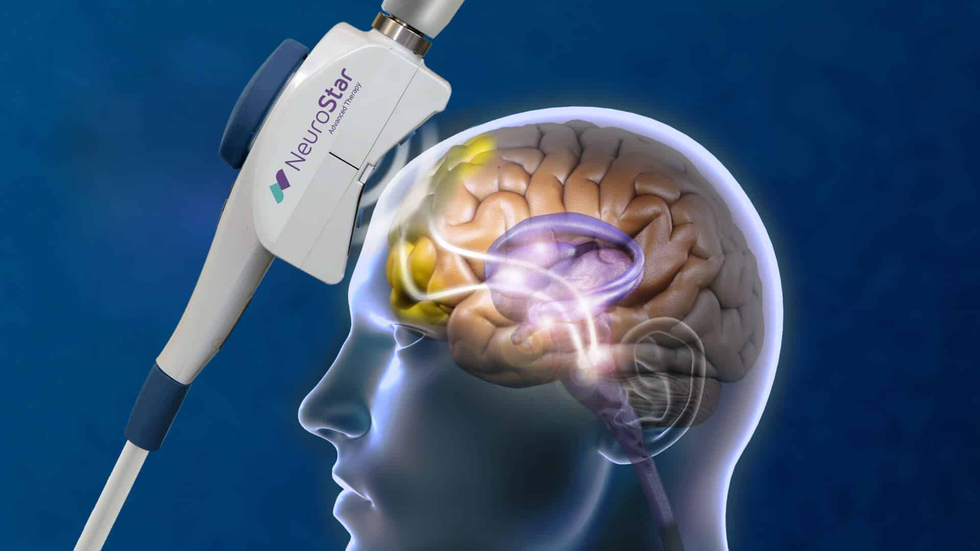 TMS Therapy Approved for Ages 15 and Up